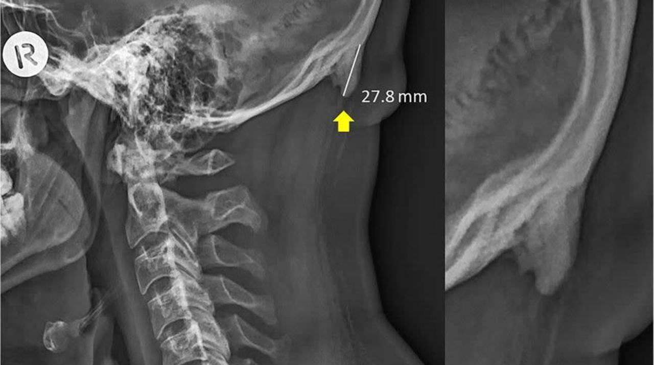 みんなが大騒ぎしてる スマホのせいで頭蓋骨にツノが生えた はホント ギズモード ジャパン