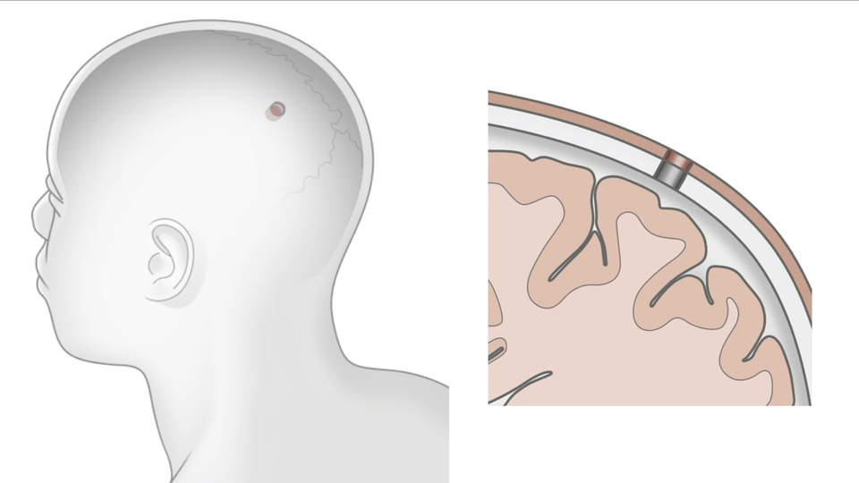 20190717-neuralink-hello-world-06