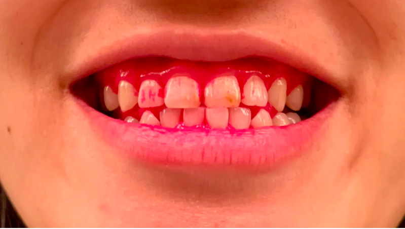 191105OralBGeniusX5