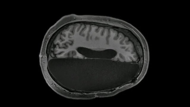 半分になった脳でも、正常な脳の神経ネットワークを凌駕できることが判明