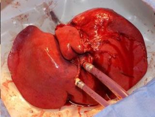 200116liver3