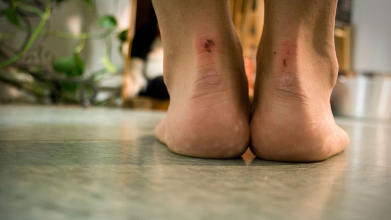 かさぶたをはがしたくなる理由と それを避ける方法 ライフハッカー 日本版