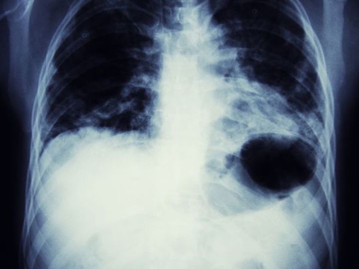 免疫治療で肺がんに勝利。アメリカの研究で明らかに