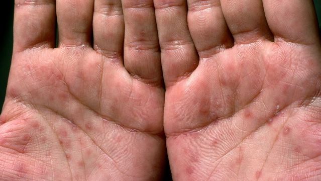 キスだけでもうつる「梅毒」がいま増加中! 初期サインを見すごさ