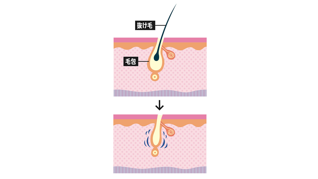 壮年性脱毛症の兆候