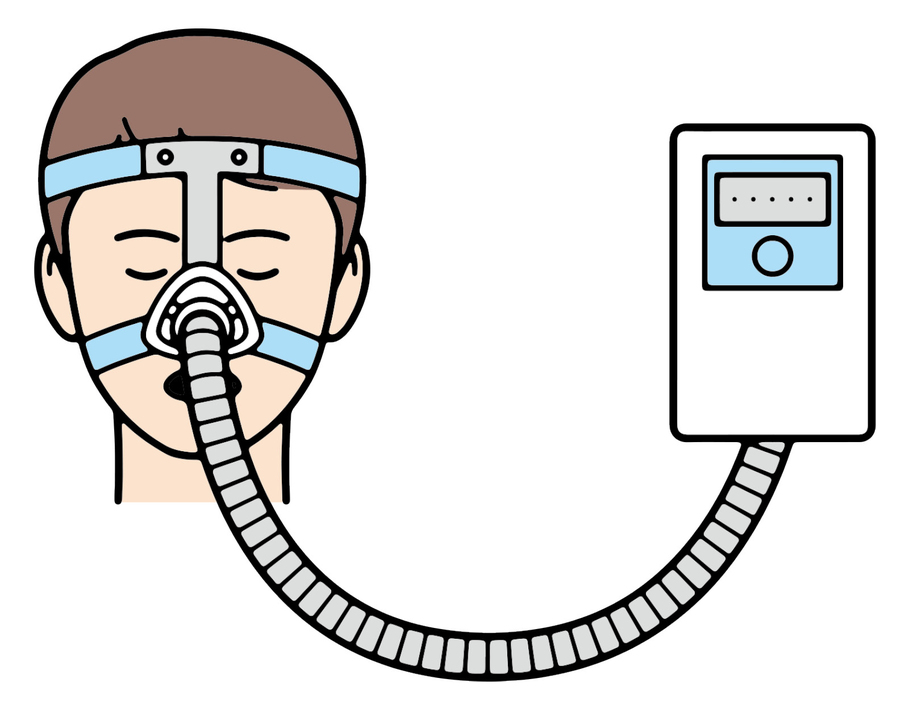 現時点でのいびき対策最終兵器、CPAPは重症患者にも効果。