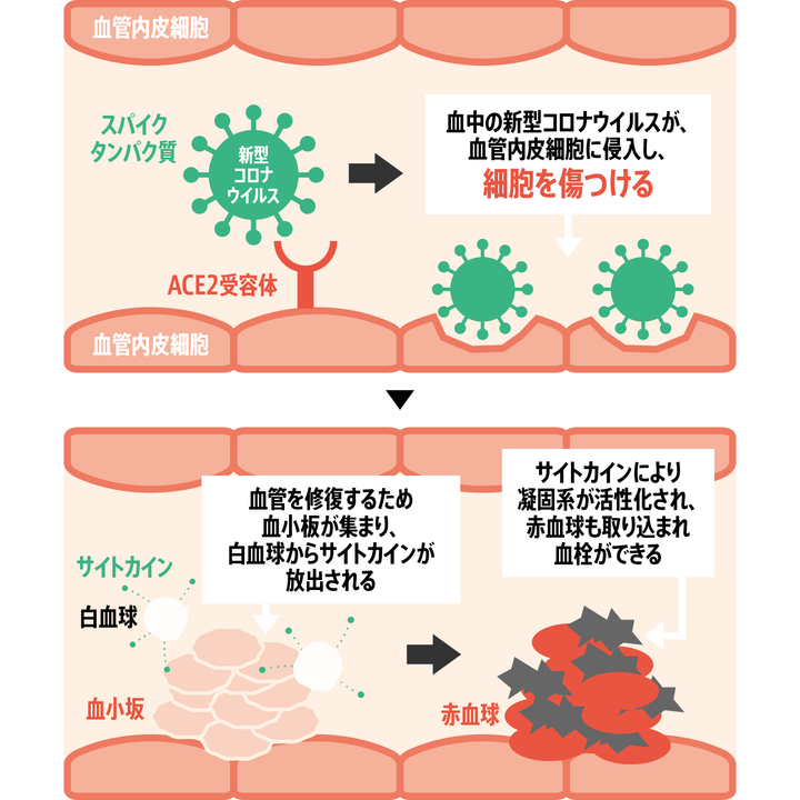 新型コロナで初期に血栓が発生する仕組み