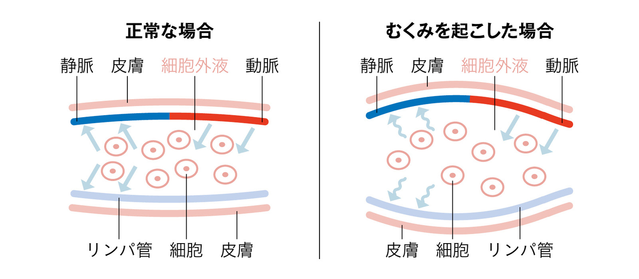 むくみのメカニズム
