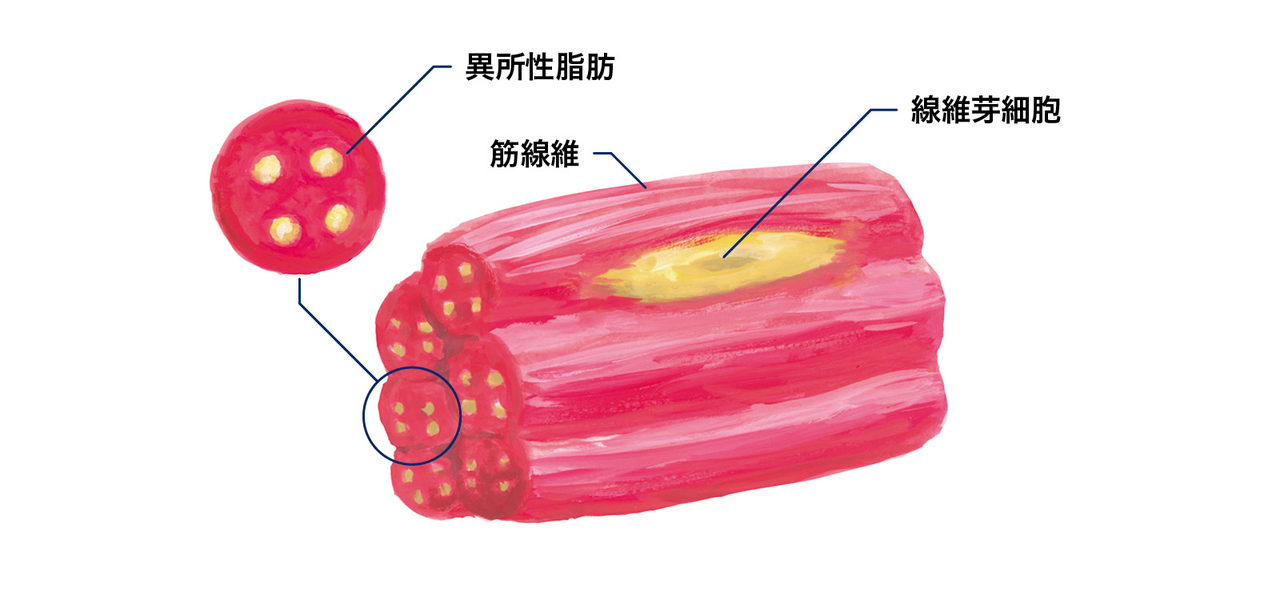 筋肉内の異所性脂肪の溜まり方