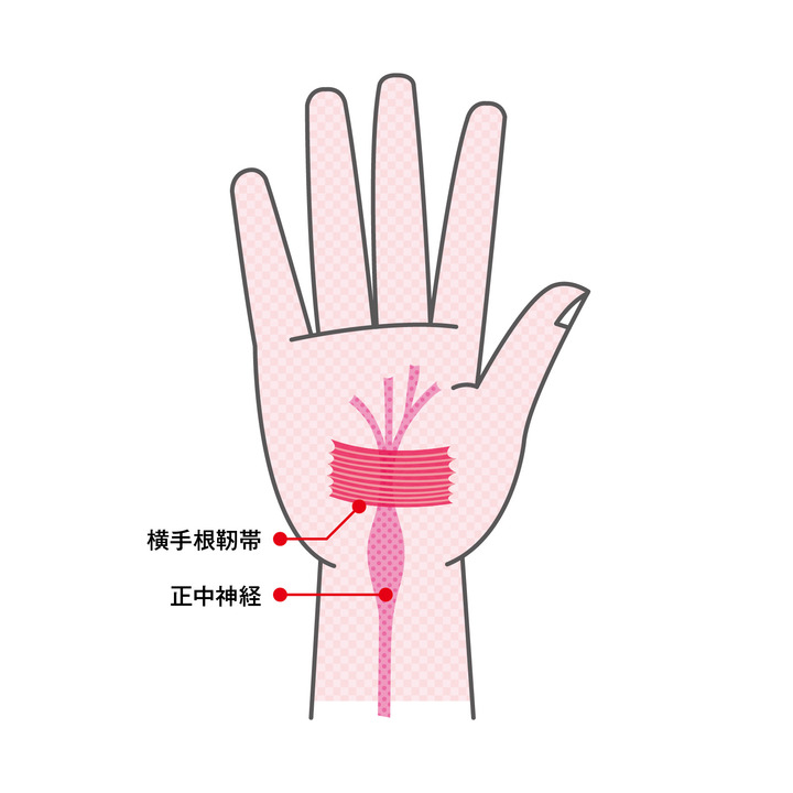 手根管症候群