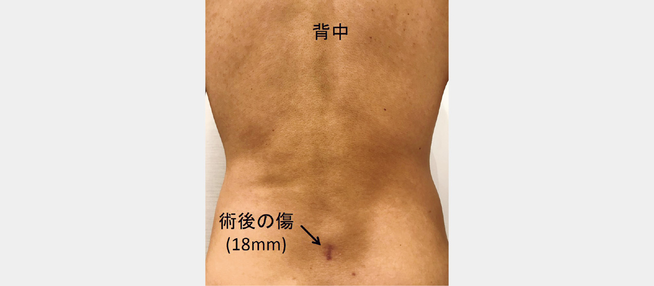 内視鏡でヘルニアを摘出する手術を行った後の傷