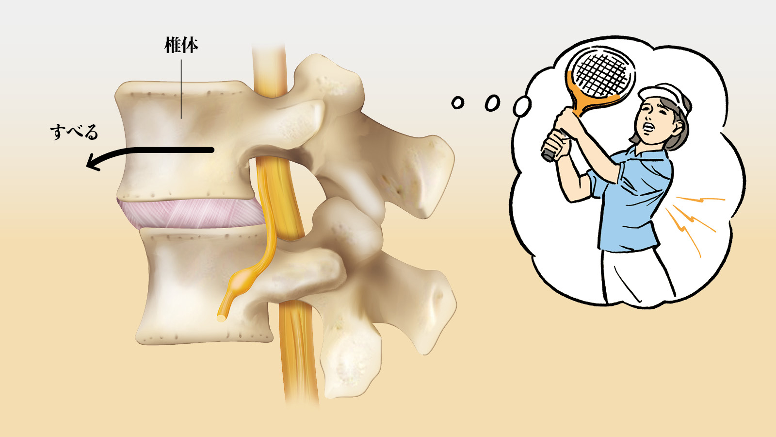 立ち仕事を続けていると腰痛がひどい それ 腰椎変性すべり症 かも Tarzan Web ターザンウェブ