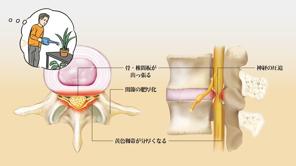 最前線医療の診察を簡易シミュレーション|脊柱管狭窄症の場合