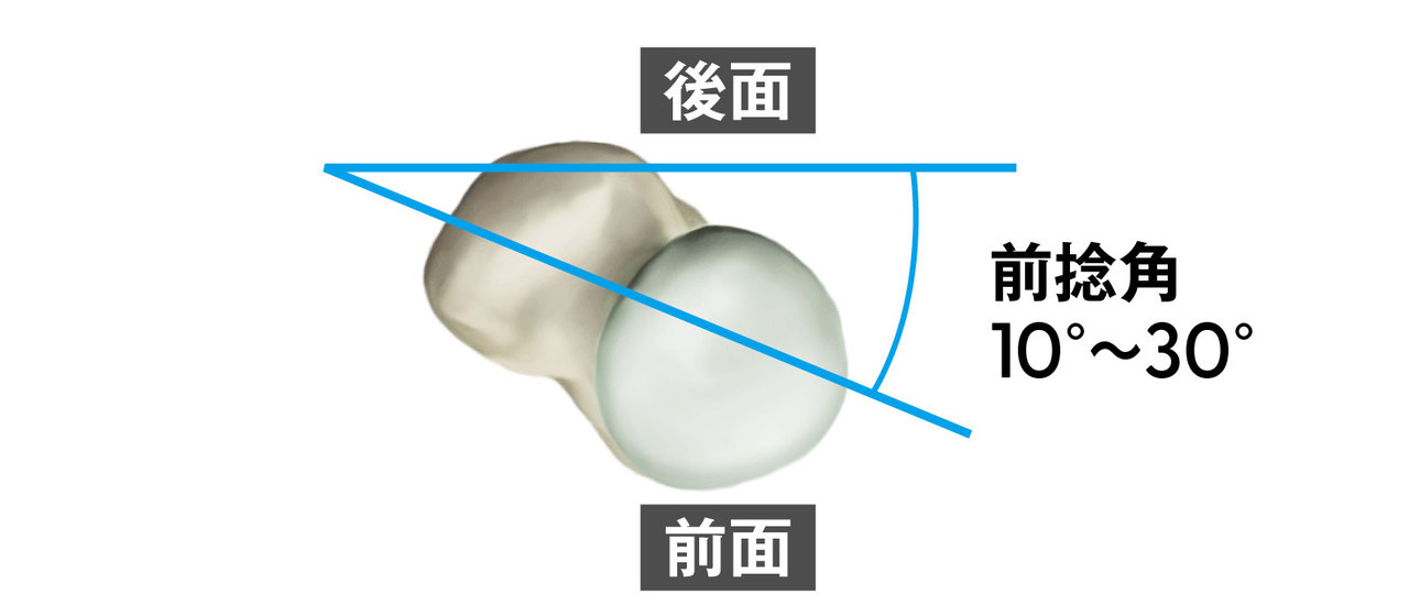 大腿骨の前捻角